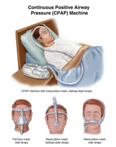 Через трубку аппарат обеспечивает постоянное давление воздуха, поддерживая дыхательные пути открытыми, предотвращая храп и апноэ во сне